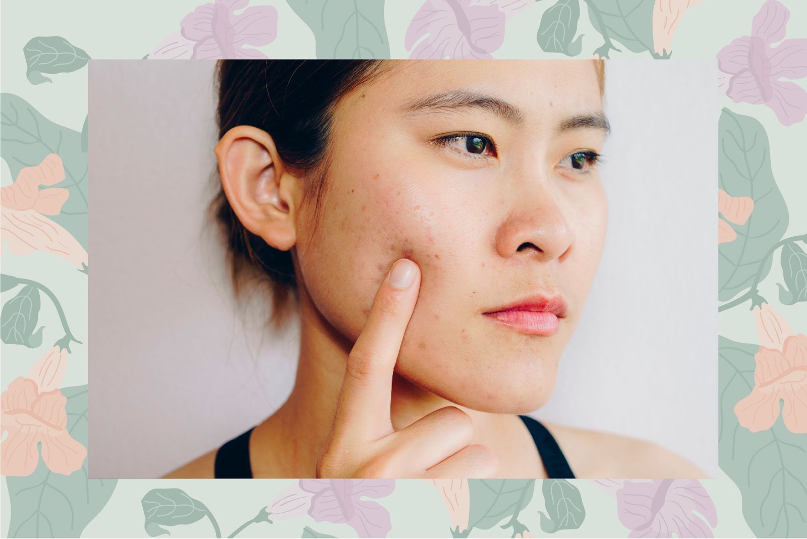 What Causes Hormonal Acne and How To Treat It
