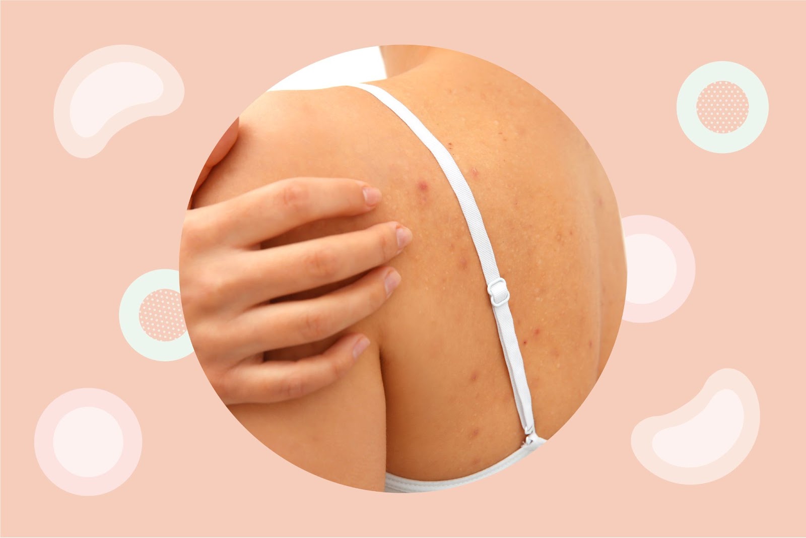 Back Acne: What is it and How to Get Rid of It | Rael