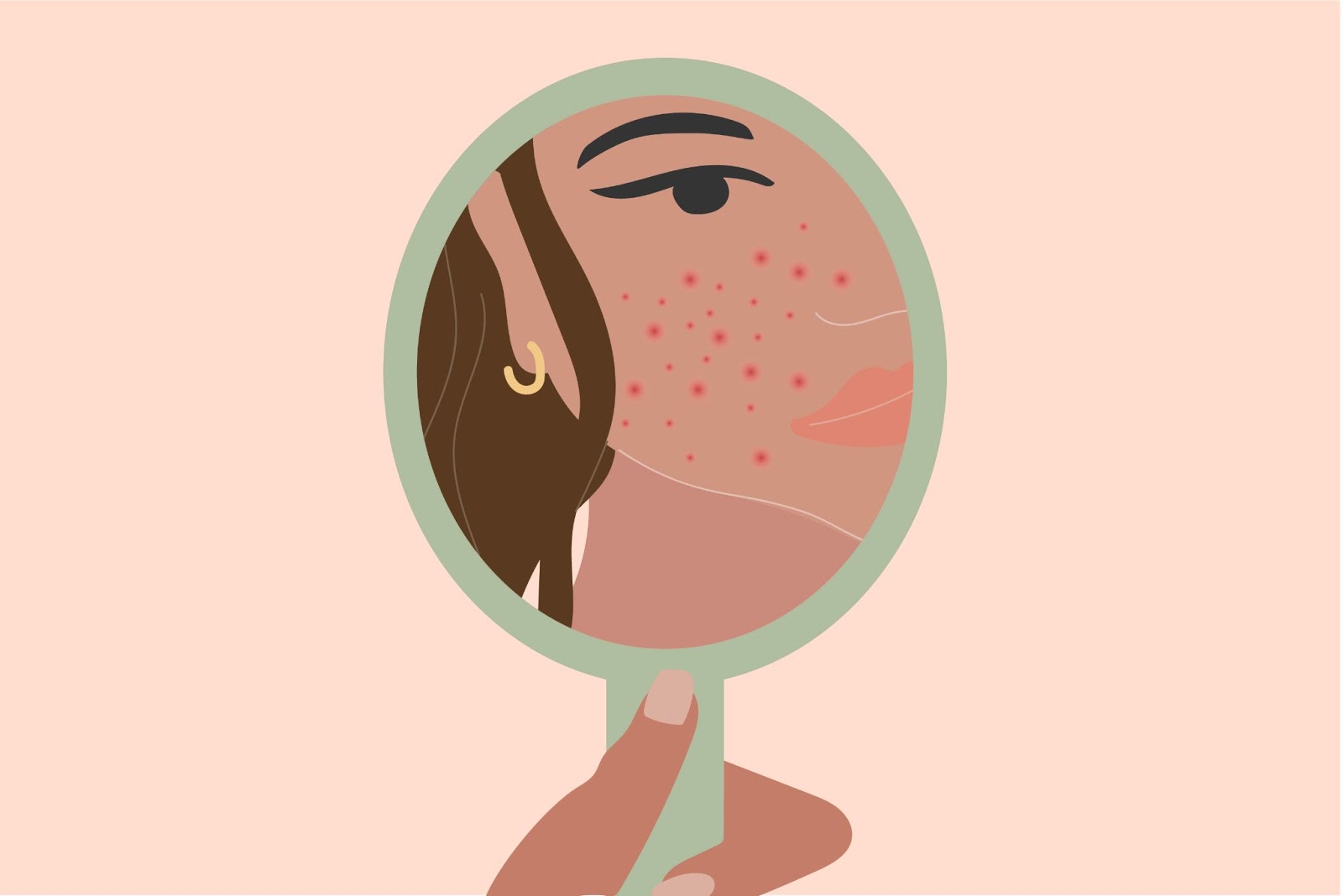 Drawing of a woman looking at acne in a hand mirror.