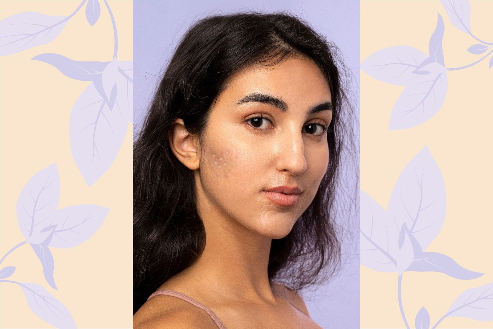 Dark haired woman with whiteheads on her face against a purple and white background.