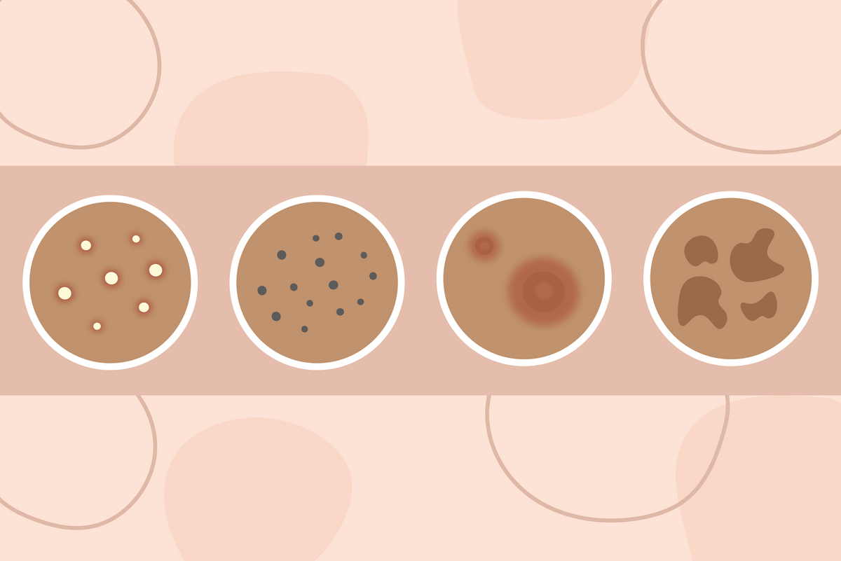 How Pimples Work Stages of a Pimple: The Complete Guide β Rael