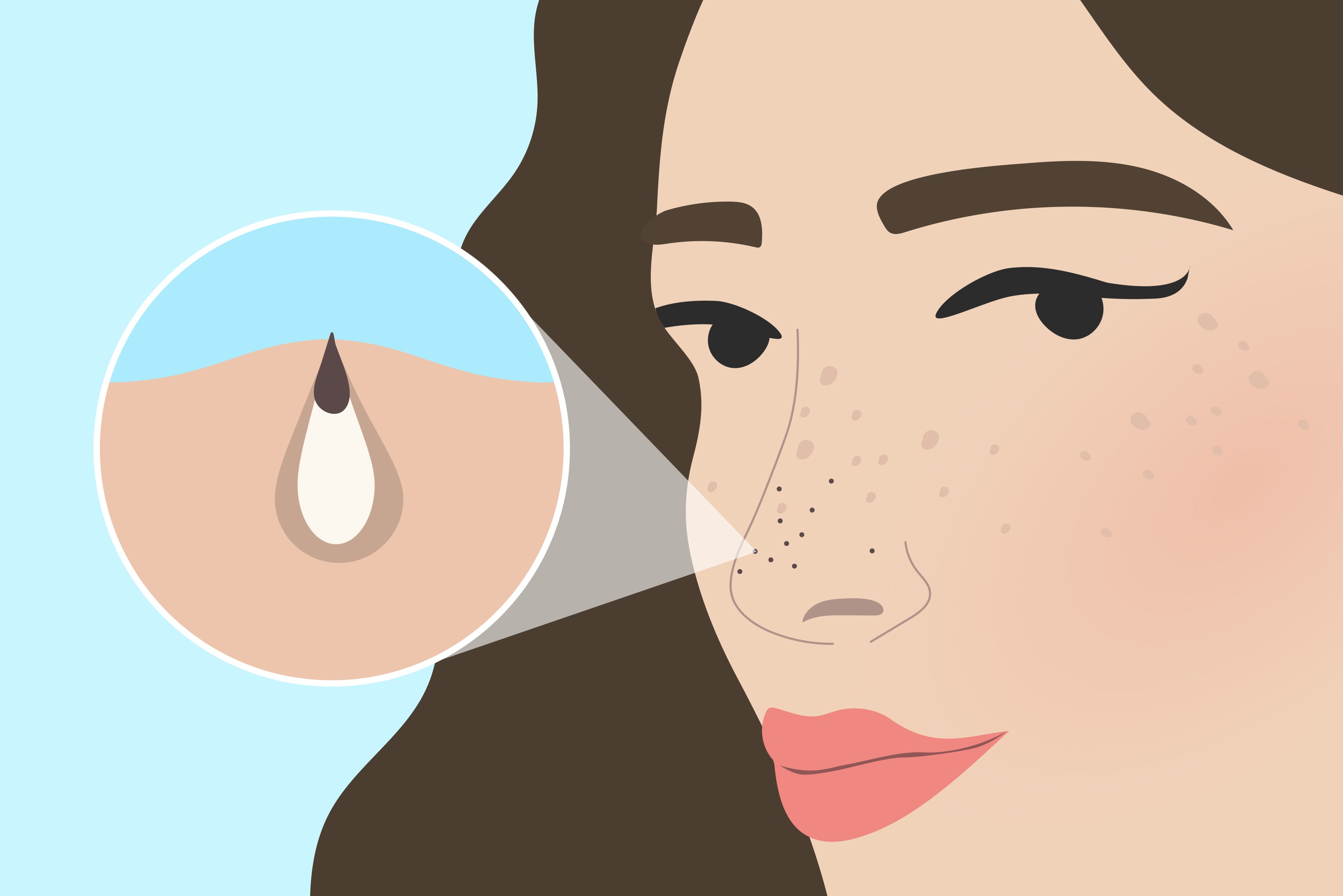 Close up drawing of a blackhead on a womans face.