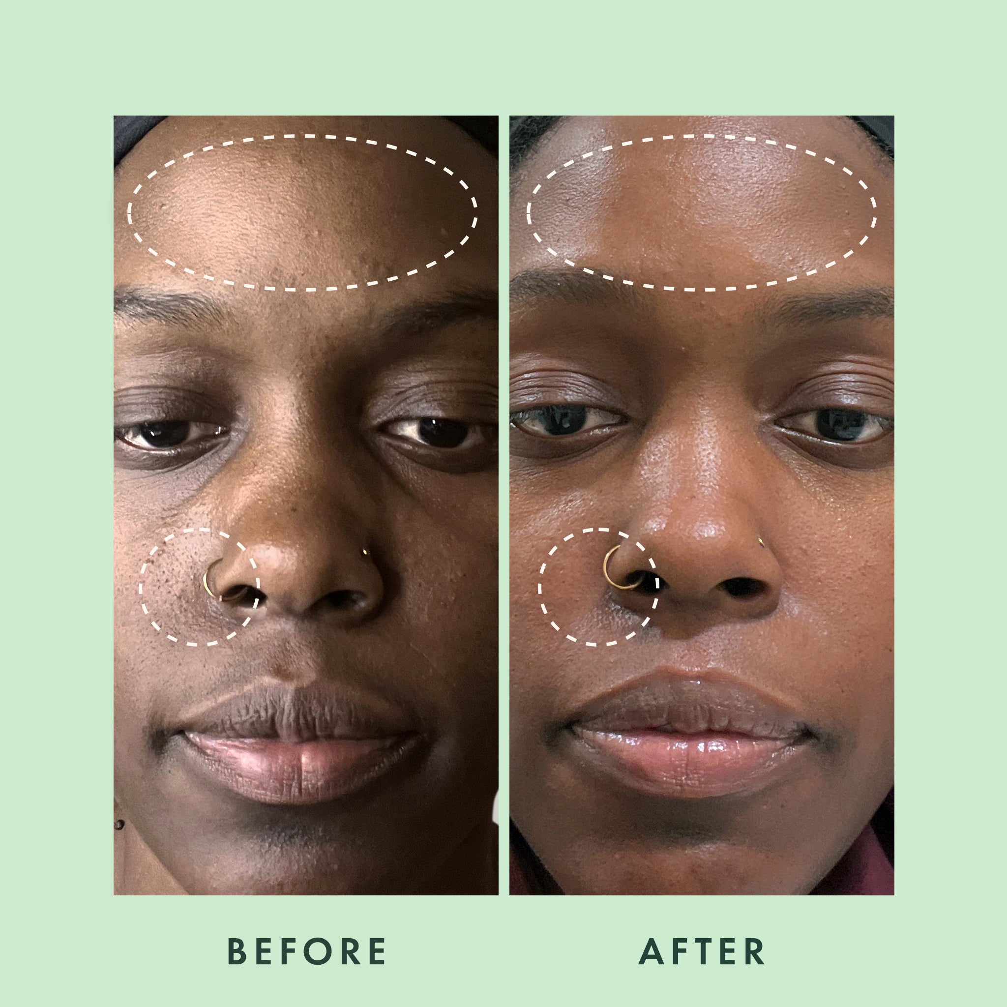 Miracle Clear Complete Acne Serum | Rael