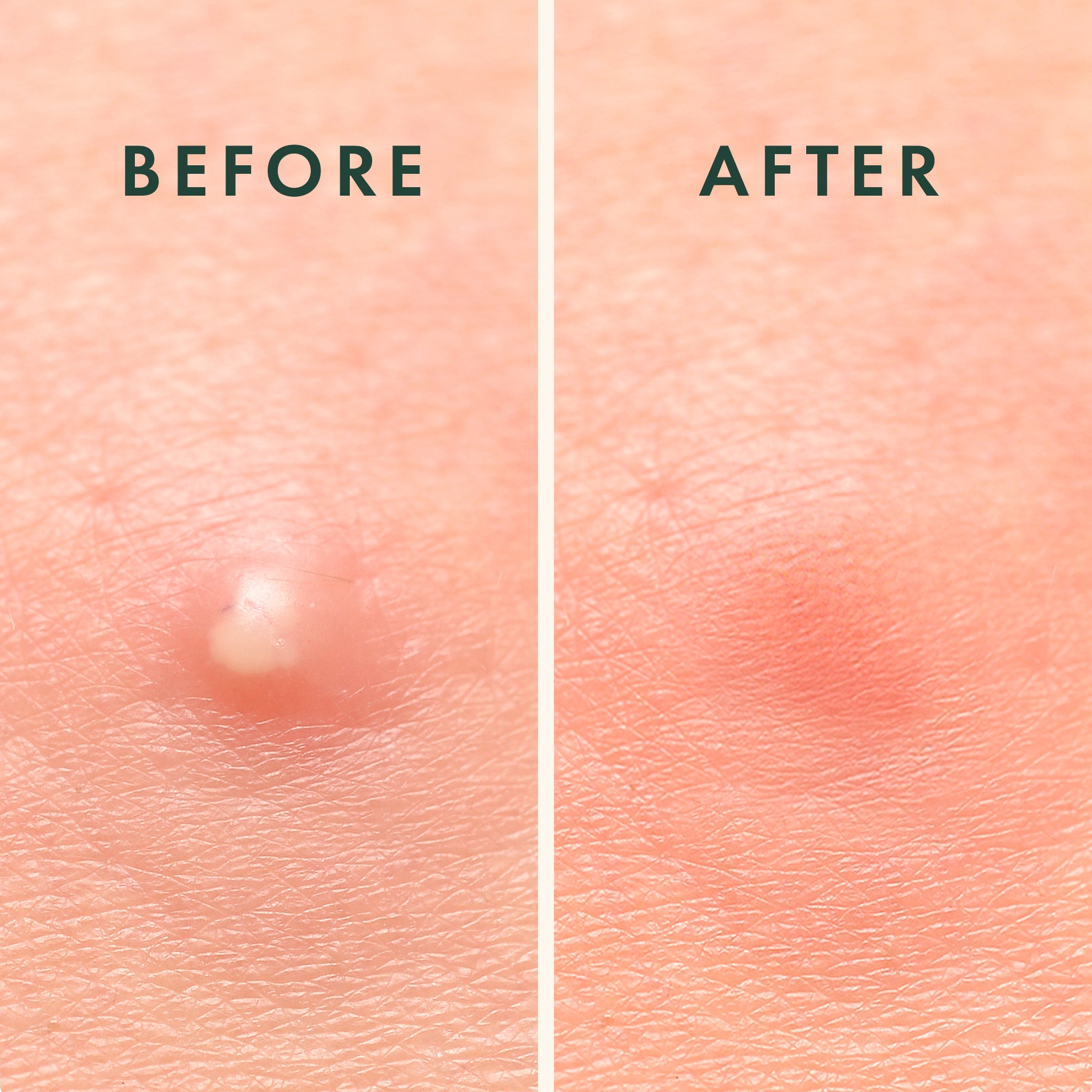 Before and After Wearing Invisible Spot Cover for Daytime Use from Rael’s Miracle Pimple Patch Collection