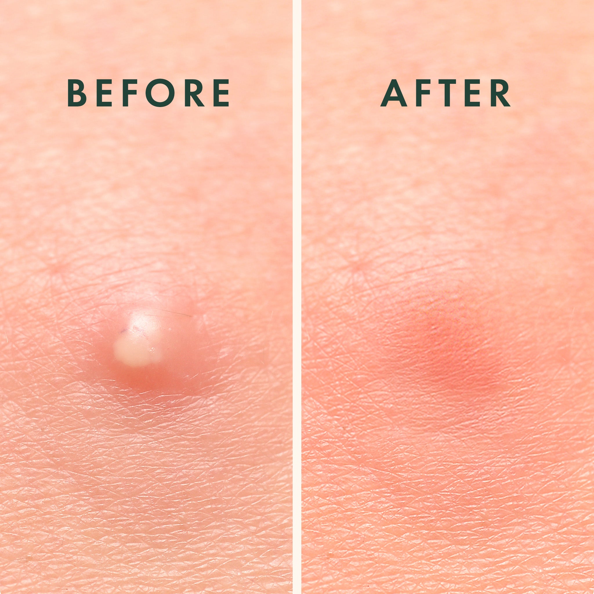 How to Use Acne Patch: Clear Skin Quickly!
